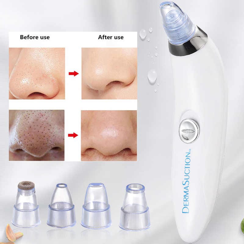 Electric Blackhead Remover Vacuum | Pore Cleaner & Acne Extractor with 4 Suction Heads | Facial Deep Cleansing Device for Men & Women